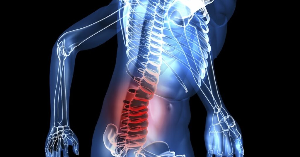 Radiografía de columna vertebral, identificando un trastorno musculoesquelético tratable con el Método Ovando Sanders