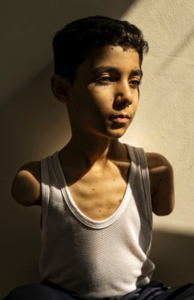 Retrato de niño palestino amputado gana el World Press Photo